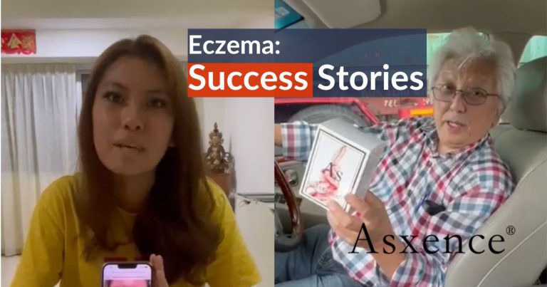 Eczema: Success Stories